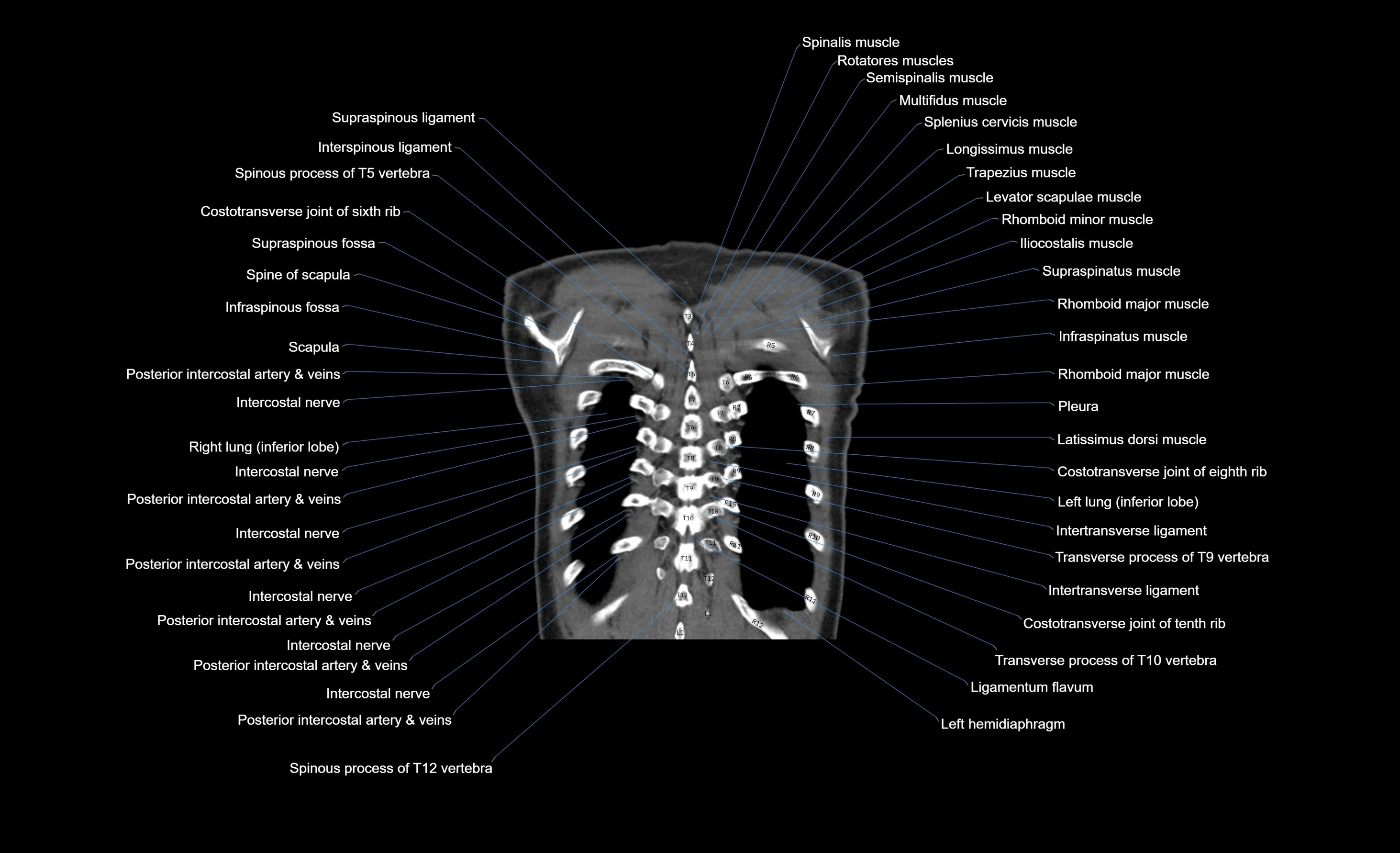 CT chest (thorax) soft tissue window labelled coronal cross sectional anatomy radiology image-00017.webp